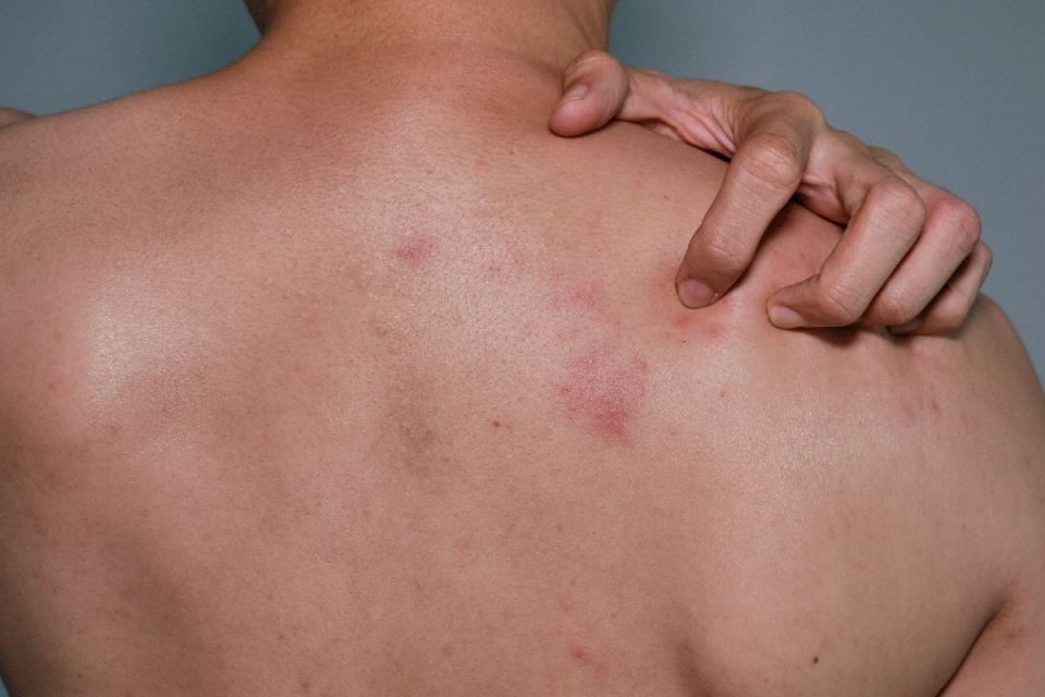 ospa herpes zoster.jpg