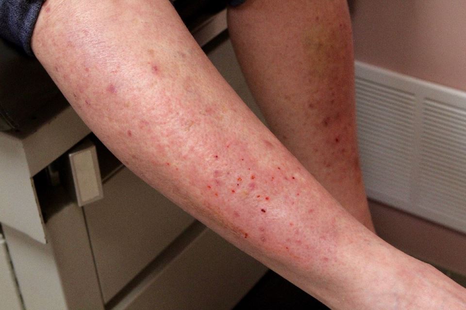 dermatitis.jpg