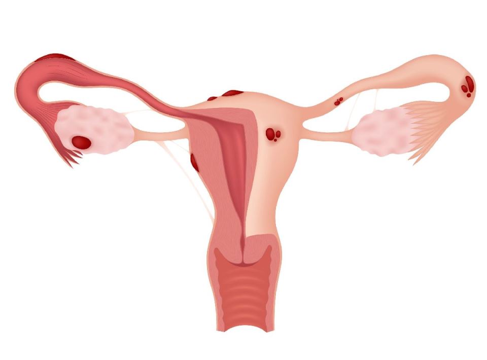 endometrioza.jpg