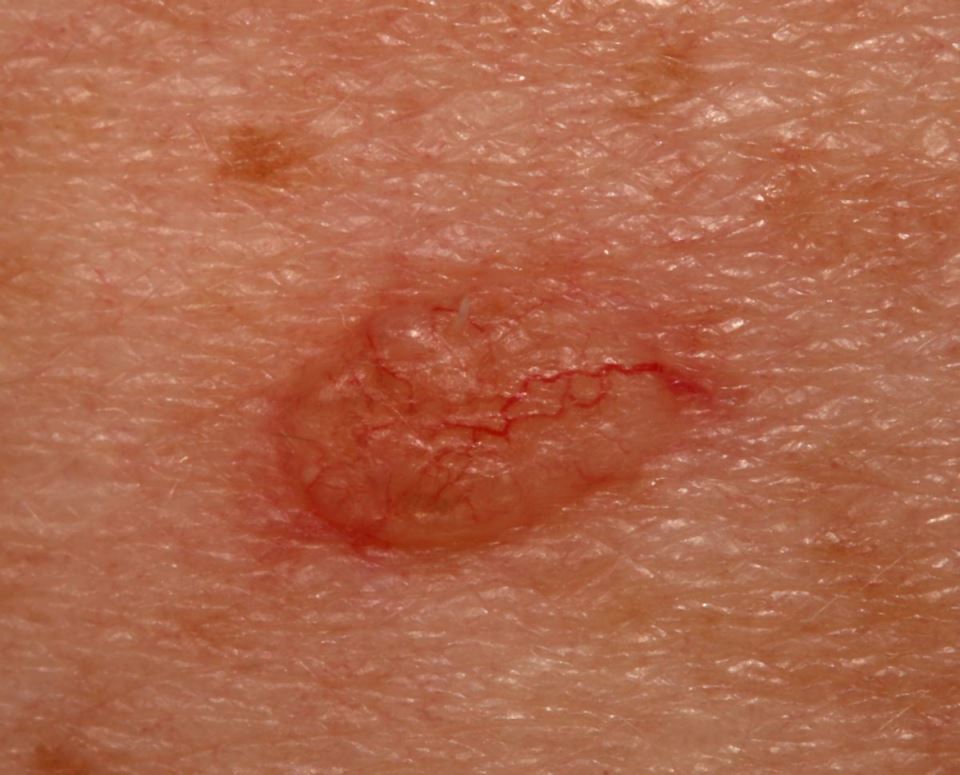 rak koze karcinom 07.jpg