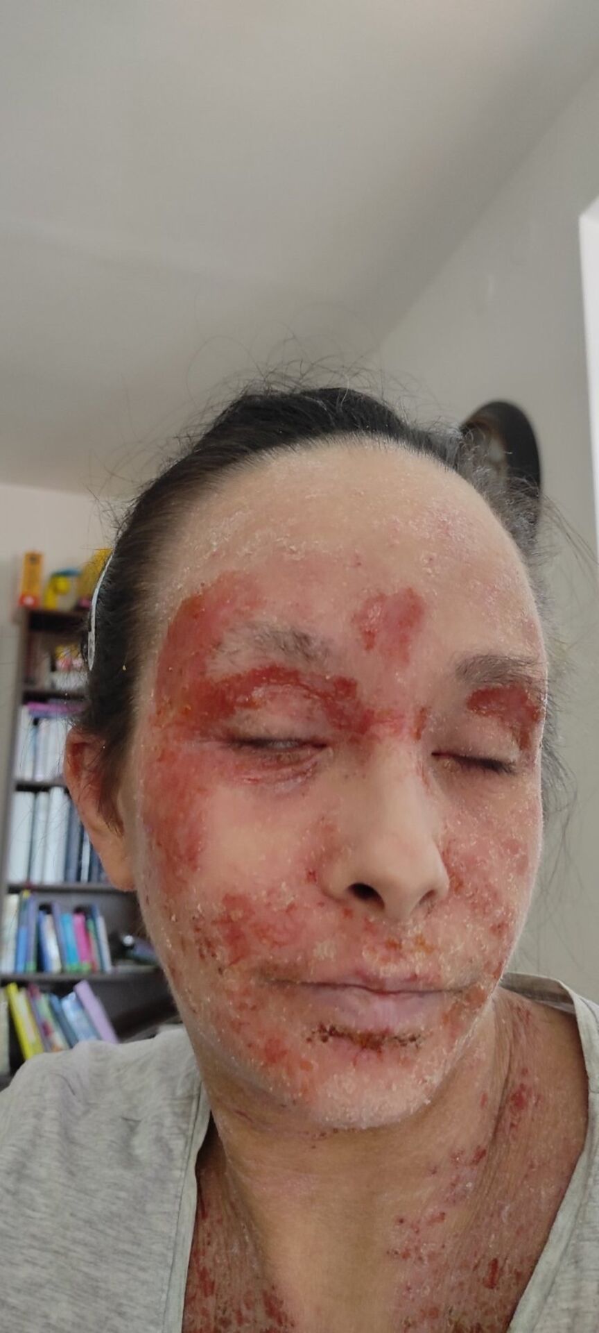 Anđela Tonić i TSW sindrom